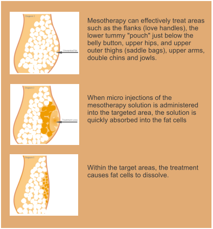 Mesotherapy can effectively treat areas such as the flanks (love handles), the lower tummy "pouch" just below the belly button, upper hips, and upper outer thighs (saddle bags), upper arms, double chins and jowls. When micro injections of the mesotherapy solution is administered into the targeted area, the solution is quickly absorbed into the fat cells Within the target areas, the treatment causes fat cells to dissolve.